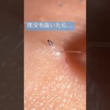 毛を抜いただけなのに